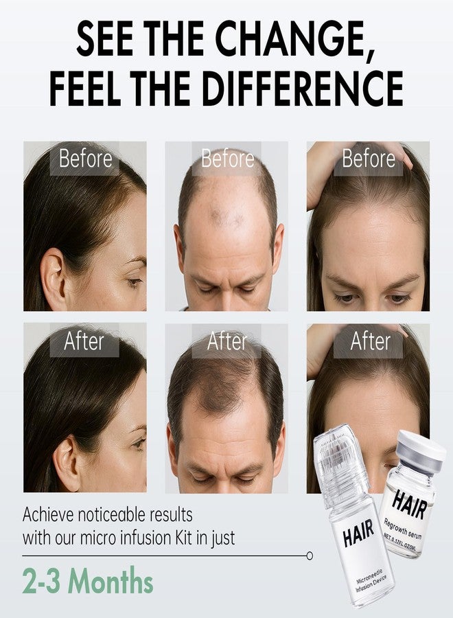 EELHOE Micro Infusion Hair Regrowth System – Hair Growth Treatment with Ginseng, He Shou Wu, Angelica & Hyaluronic Acid, Thickening Serum for Fuller, Stronger Hair – Premium Scalp & Hair Care for Men & Women - Image 5